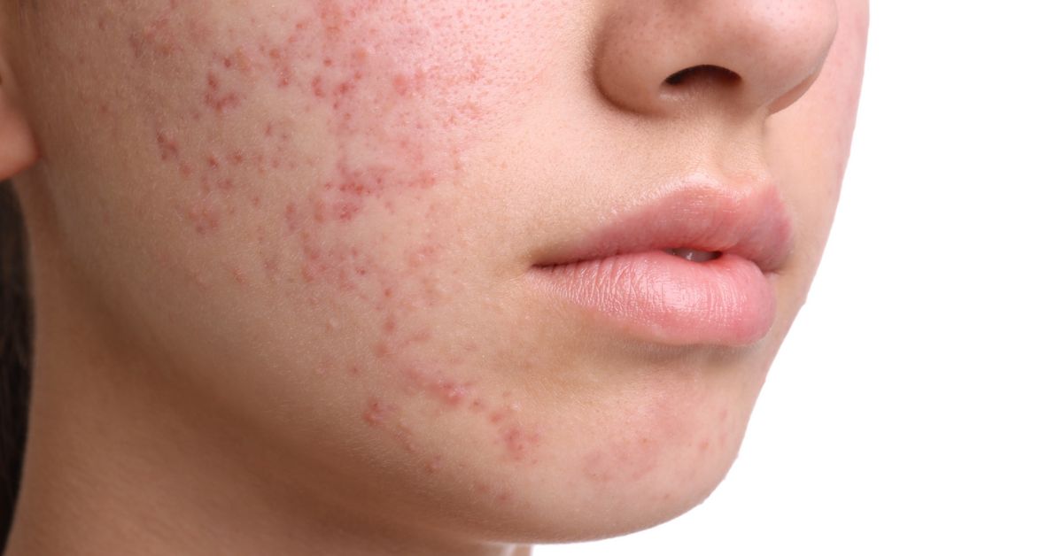 Acne littekens verwijderen