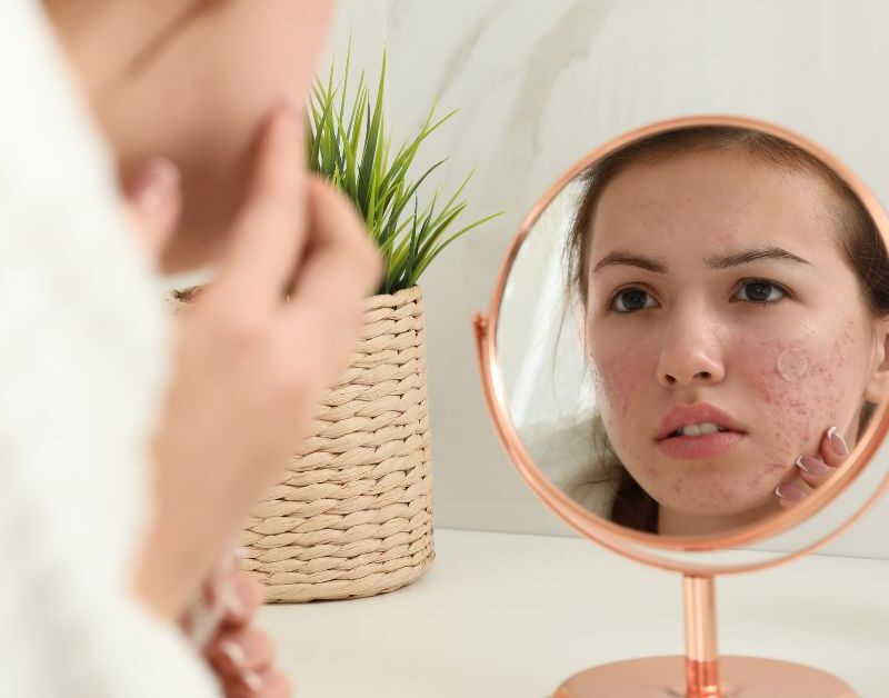 hormonale acne