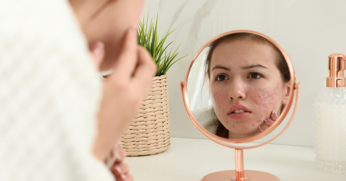 hormonale acne
