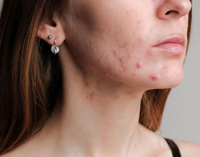 acne vulgaris