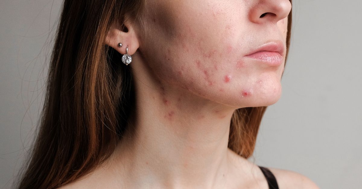 acne vulgaris