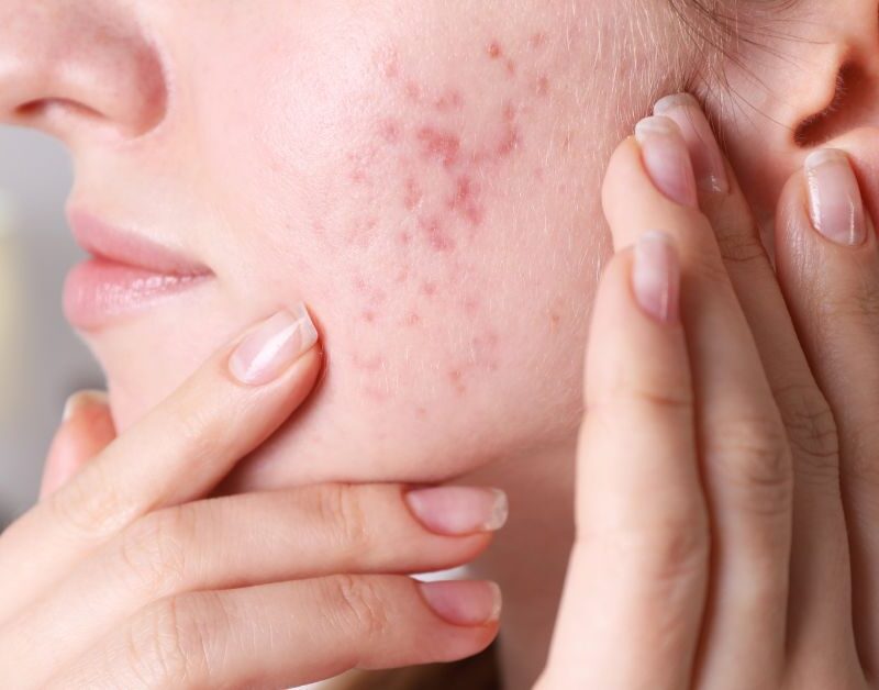 soorten acne
