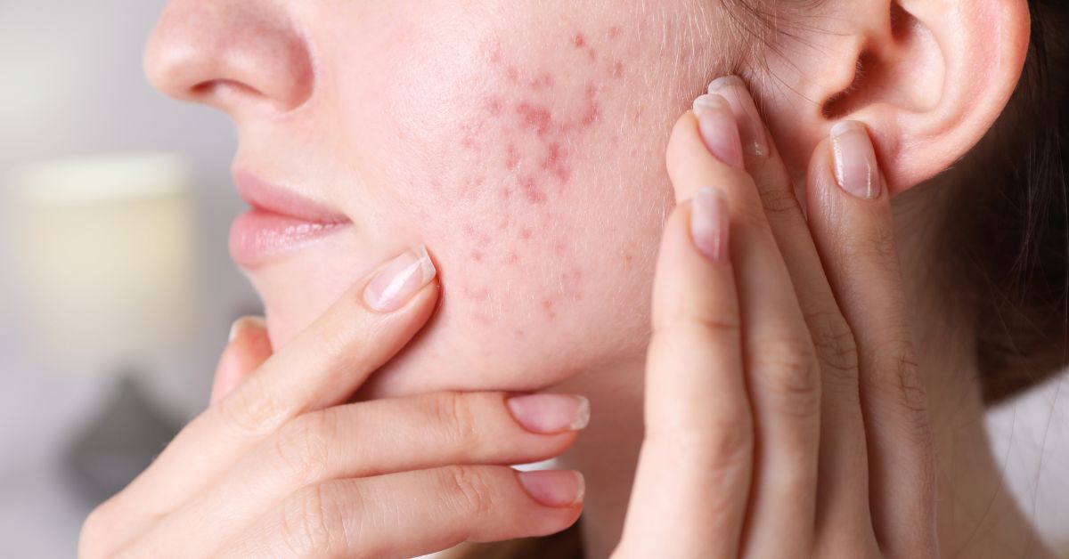 soorten acne