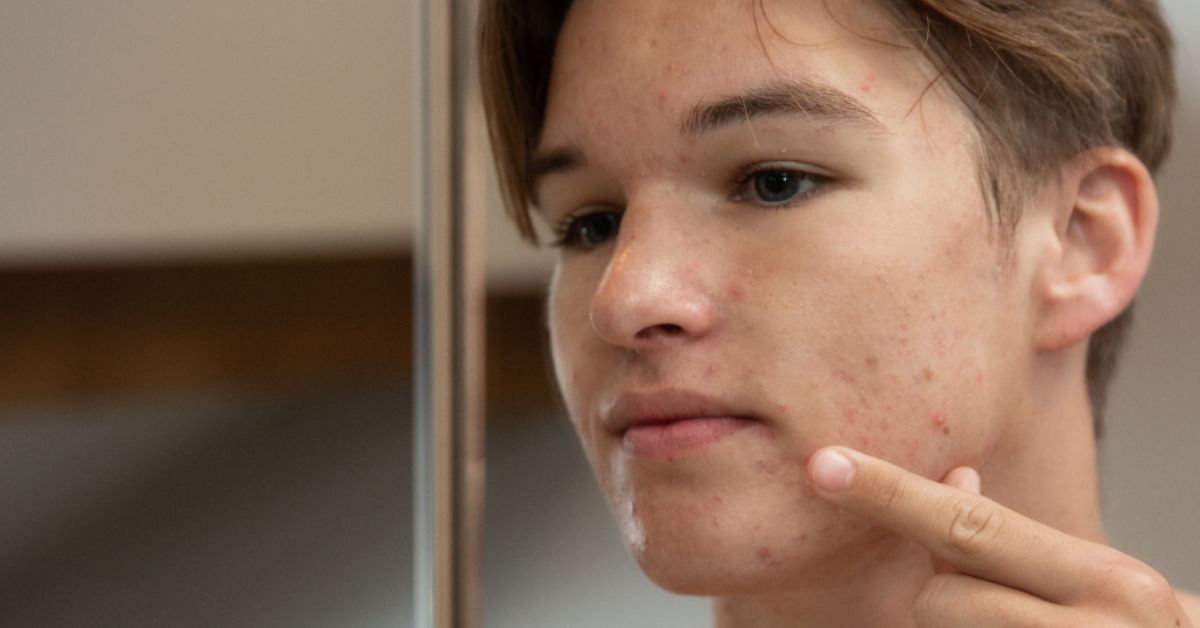 acne gezicht