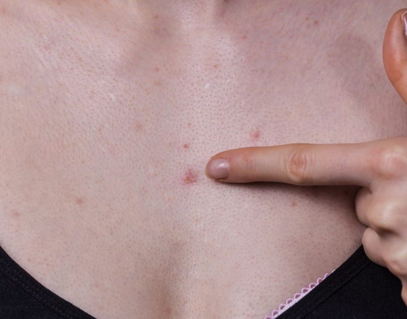 acne op borst