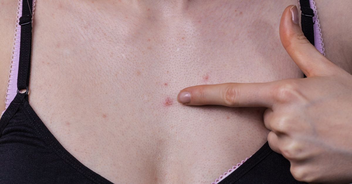 acne op borst