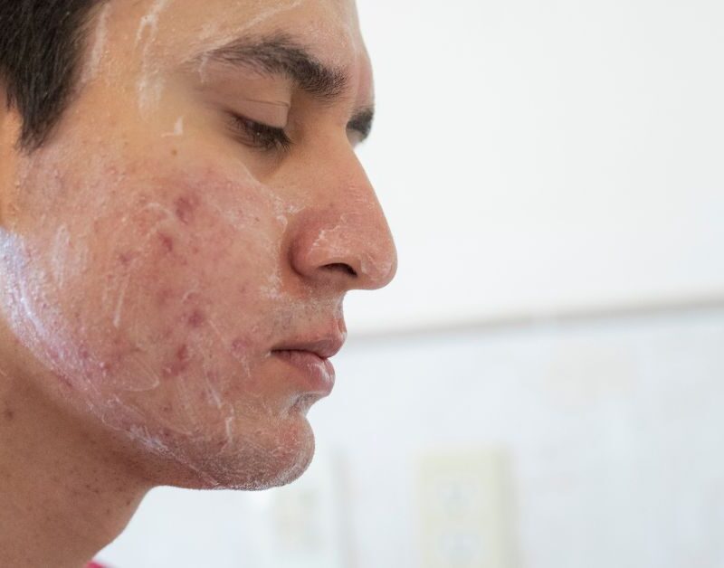 volwassen acne