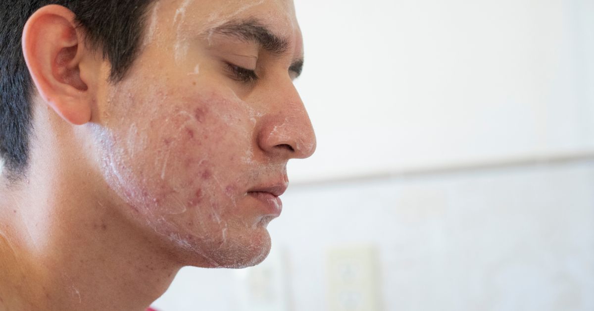volwassen acne